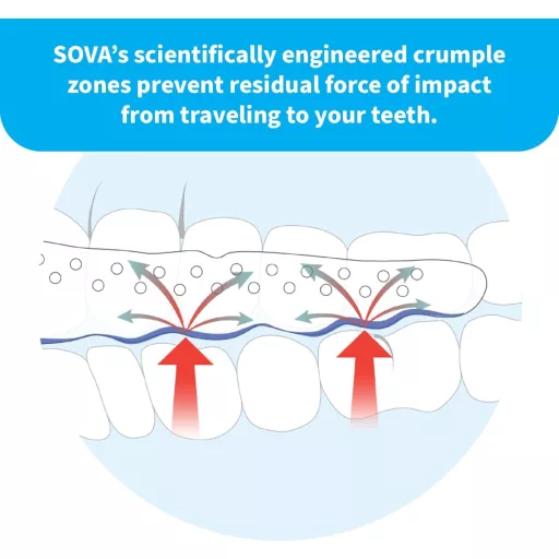 SOVA Apărătoare dentară de noapte - Apărătoare bucală personalizată pentru bruxism, pentru adulți, fără BPA, cu cutie de depozitare, Albă